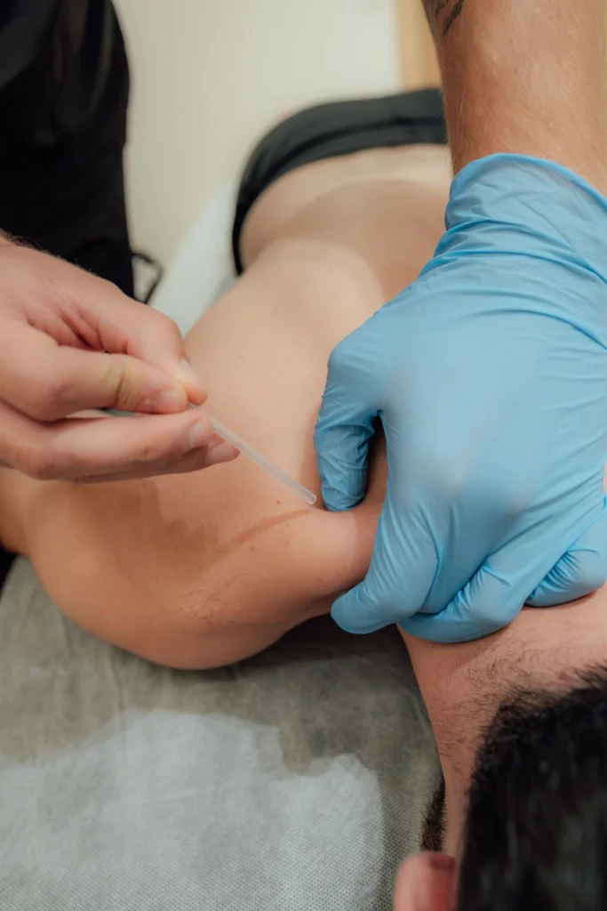 Fisioterapeuta con guantes aplicando punción seca en el hombro